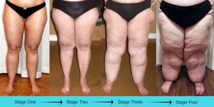 Lipedema-Stages.jpg